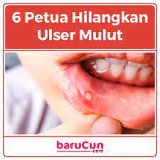 Apa sebenarnya penyebab terjadinya kutilan? Barucun Siapa Yang Selalu Kena Ulser Mulut Ni Ada 6 Facebook