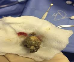 Image result for Tonsillolith