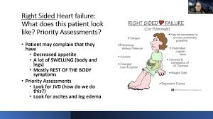 Image result for Right Heart Failure