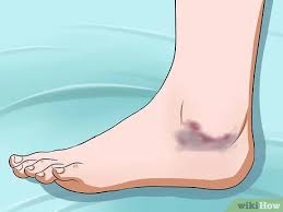 Kondisi ini dalam dunia medis adalah ankle sprain. Cara Meredakan Nyeri Pada Pergelangan Kaki 13 Langkah