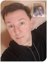 DHT Blocker with Immune Support Nutraceutical