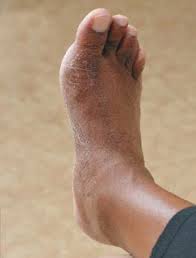 Beyond Bunionectomy; The Role Of Physical Therapy | Lower Extremity Review  Magazine