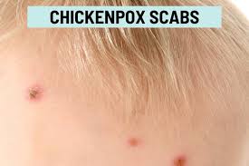 Image result for dry scabs on the head in children