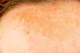 Melanin is responsible for our skin color. Hyperpigmentation Treatment Types And Causes