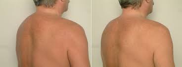 Position the muscles at the back of your neck onto a massage ball. Buffalo Hump Correction Breast Augmentation Nipple Correction Surgery San Francisco Ca Dr James Romano
