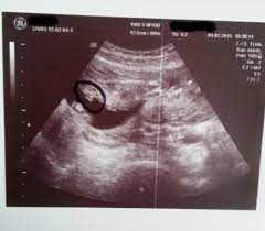 Ab wann ist die schwangerschaft feststellbar? Geschlecht Erkennen Juli 2015 Babyclub Seite 12 Babycenter