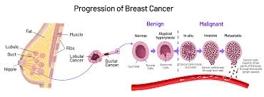 Image result for Breast Cancer