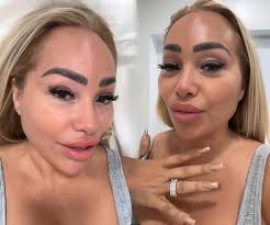 What happened to Stacey's face? That blotch