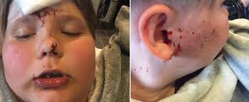 Rosult son chien avait mordu un enfant de 5 ans au visage. Un Enfant Mordu Au Visage Et Au Bras Par Un Chien A Saint Jerome Jdm