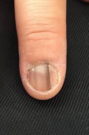 Image result for Acral lentiginous melanoma nail