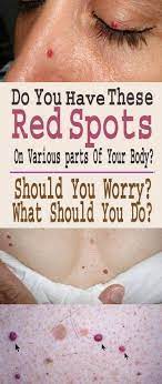 Our skin is sensitive and vulnerable to breakouts, bumps, and marks of all types, but we've all asked ourselves the same question at one point or another: Simple Ways To Remove Red Spots On The Skin Red Skin Spots Red Spots On Face Pimples On Face
