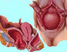 Vail n'a qu'un rôle moalli et al., dans leur étude de cohorte, ont montré que les femmes prenant un traitement hormonal. Descente D Organe Cure De Prolapsus Genital Dr Velemir