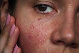 Jun 30, 2019 · how to get rid of redness on face: Reducing Skin Redness Dermafix Advanced Skin Care Solutions