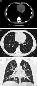 Hypoplasia of the sphenoid sinuses as a diagnostic tool in cystic fibrosis. Image Quality Comparison Between Model Based Iterative Reconstruction And Adaptive Statistical Iterative Reconstruction Chest Computed Tomography In Cystic Fibrosis Patients Lin 2019 Journal Of Medical Imaging And Radiation Oncology Wiley