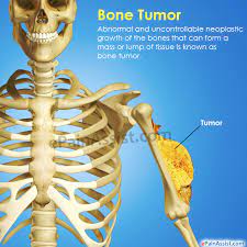 Although these malignancies account for less . Bone Tumor Types Symptoms Treatment Survival Period