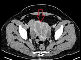 Ct scans can produce detailed images of many structures inside the body, including the internal organs, blood vessels and bones. Cureus Rare Case Report Of An Endometrial Adenocarcinoma Arising In A Complete Septate Uterus With A Double Cervix And Vagina