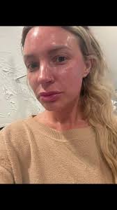 Happy peeling! #chemical #chemicalpeeling #skincare #over30club #momof...