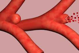 Un aneurisma es una protuberancia o dilatación que ocurre en algunas arterias del cuerpo. Aneurisma Causas Sintomas Y Tratamiento
