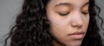 Hormonelle Hautveränderung