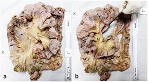 Frontiers Development Of A Novel Technique To Dissect The Mesentery That Preserves Mesenteric Continuity And Enables Characterization Of The Ex Vivo Mesentery Surgery