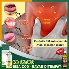 Nutrisi juga berperan penting dalam menjaga kesehatan gigi dan gusi. Jual Propolis Sm Original Obat Panas Dalam Alami Gusi Bengkak Infeksi Radang Gusi Gusi Ngilu Gusi Berdarah Bernanah Sariawan Benjolan Gusi Di Lapak Propolis Sm Banten Bukalapak