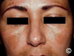 Image result for Melasma
