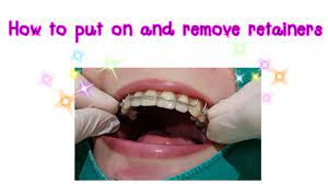 The attorney should provide a retainer agreement detailing the retainer fee and how to proceed if the fee is depleted. How To Put On And Remove Retainer Youtube