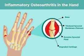 How to know if you have arthritis in your hand. Hand Osteoarthritis Is Worse When It Affects Your Fingers And Base Of Thumb