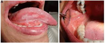 Image result for lichen planus on tongue)