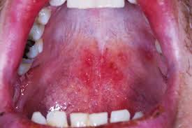 Image result for Canker sores symptoms roof of the mouth