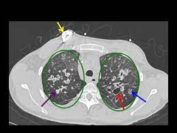 Cystic fibrosis is an inherited disease characterized by the buildup of thick, sticky mucus that can damage many of the body's organs. Cystic Fibrosis Diagnosis And Treatment