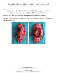 Other health conditions can cause the same symptoms as cancer of the renal pelvis or ureter. Rupture Of The Renal Pelvis Of A Ureteropelvic Junction Hydronephrosis After Blunt Abdominal Trauma