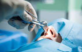 Image result for Sinus Surgery