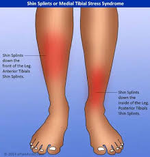 Image result for Shin Splints