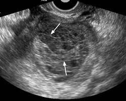 Image result for corpus luteum sonography)
