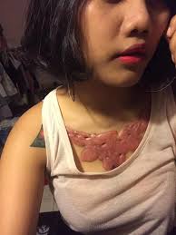 Ayurveda students aand teachers , practitioners can take part. Keliods And Tattoos Did You Know That Keloids Awareness In Zambia Facebook