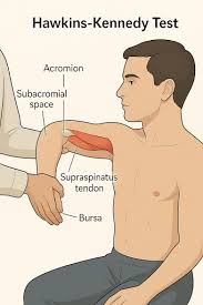 Image result for Hawkins Test