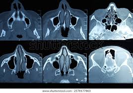 Image result for Sinus X Ray