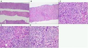 Sarcoidosis with cancer immunotherapy, mistaken for cancer progression. Multisystemic Sarcoidosis Important Lessons Learnt From One Of The Great Imitators Bmj Case Reports