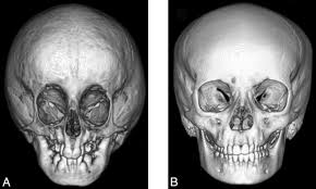 Craniofacial Abnormalities In Hutchinson Gilford Progeria