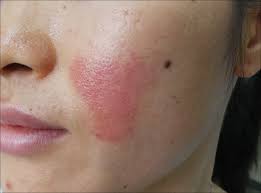 Image result for red rash face
