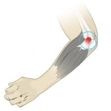 Back Pain Image