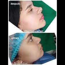 Armonización Orofacial Dra Luisa Ruiz Saltillo