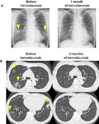 Aspergillosis is the name given to a wide variety of diseases caused by fungal infections from species of aspergillus. Allergic Bronchopulmonary Aspergillosis Successfully Treated With Benralizumab The Journal Of Allergy And Clinical Immunology In Practice