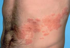 Image result for shingles