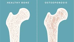 Few of the main bones. Osteoporosis 15 Foods To Improve Bone Health Dr Ashwin Karuppan