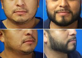 Loss of hair on the top of your head can be traumatic, but a lesser known problem that afflicts a lot of men is beard growth trouble. Beard Hair Transplant Facial Hair Restoration Hartford Ct