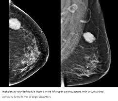 What is the normal function of these genes? Mucinous Carcinoma Of The Breast A Case Report And Review Of The Literature Medwave