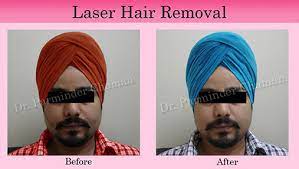 We have extensive experience in skin, laser & hair transplantation. Laser Hair Removal In Chandigarh