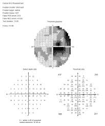Figure 3 Stimulus V 30 2 Humphrey Visual Field Demonstrates A Cecocentral Scotoma In The Right Eye Abbreviations Pos Pos Negativity Positivity Abbreviations